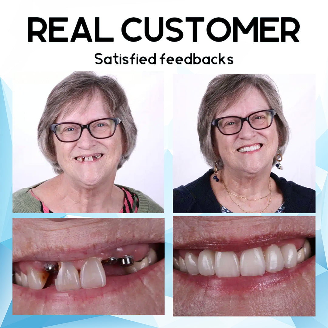Suptruck™ Silicone Reline Denture Kit 🔥 LAST DAY SALE 75% OFF 🔥