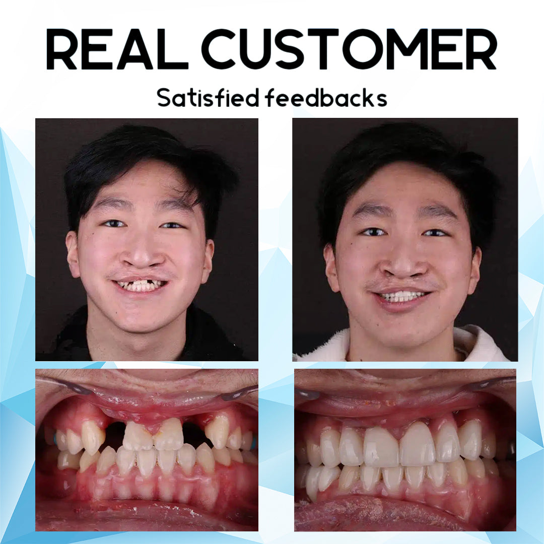 Suptruck™ Silicone Reline Denture Kit 🔥 LAST DAY SALE 75% OFF 🔥