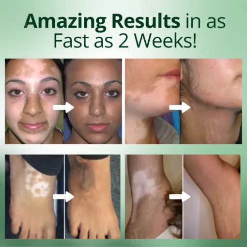 💥 2025 Hot Sale 70% OFF 🔥 Melavix Vitiligo Treatment Cream 🔆 Bring Balance Back to Your Skin