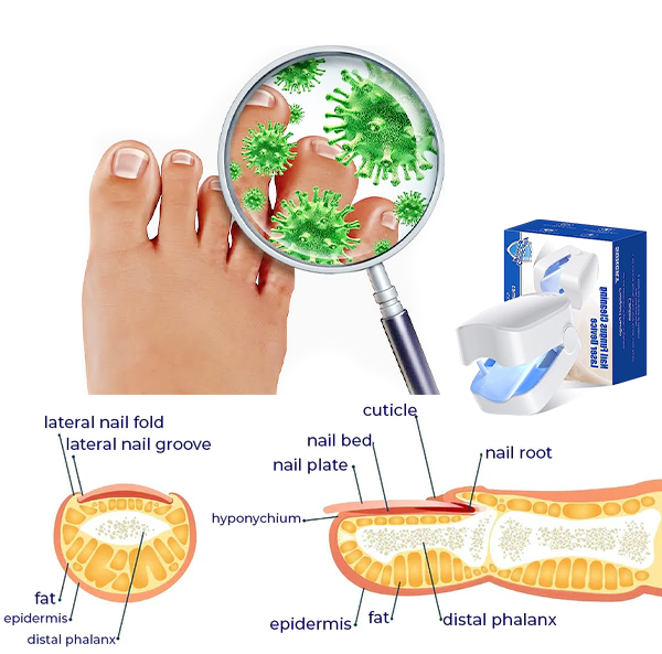 Suptruck™ Revolutionary High-Efficiency LED Light Therapy Device For Toenail Diseases