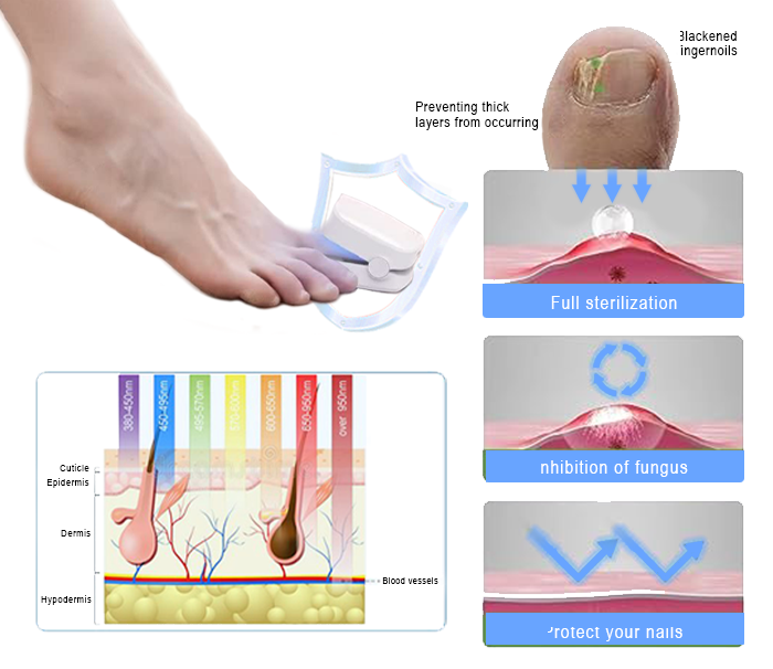 Suptruck™ Revolutionary High-Efficiency LED Light Therapy Device For Toenail Diseases