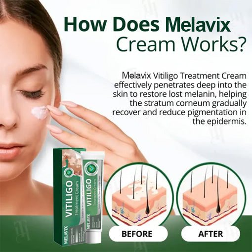 💥 2025 Hot Sale 70% OFF 🔥 Melavix Vitiligo Treatment Cream 🔆 Bring Balance Back to Your Skin