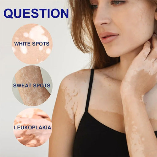 ๐ฅ 2025 Big Sale 70% OFF ๐ฅ Vitacure Antibacterial Vitiligo Cream ๐ Gentle Touch - Visible Change