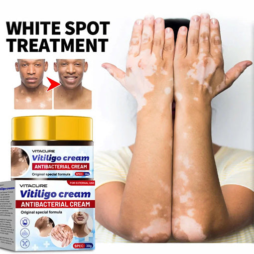 ๐ฅ 2025 Big Sale 70% OFF ๐ฅ Vitacure Antibacterial Vitiligo Cream ๐ Gentle Touch - Visible Change