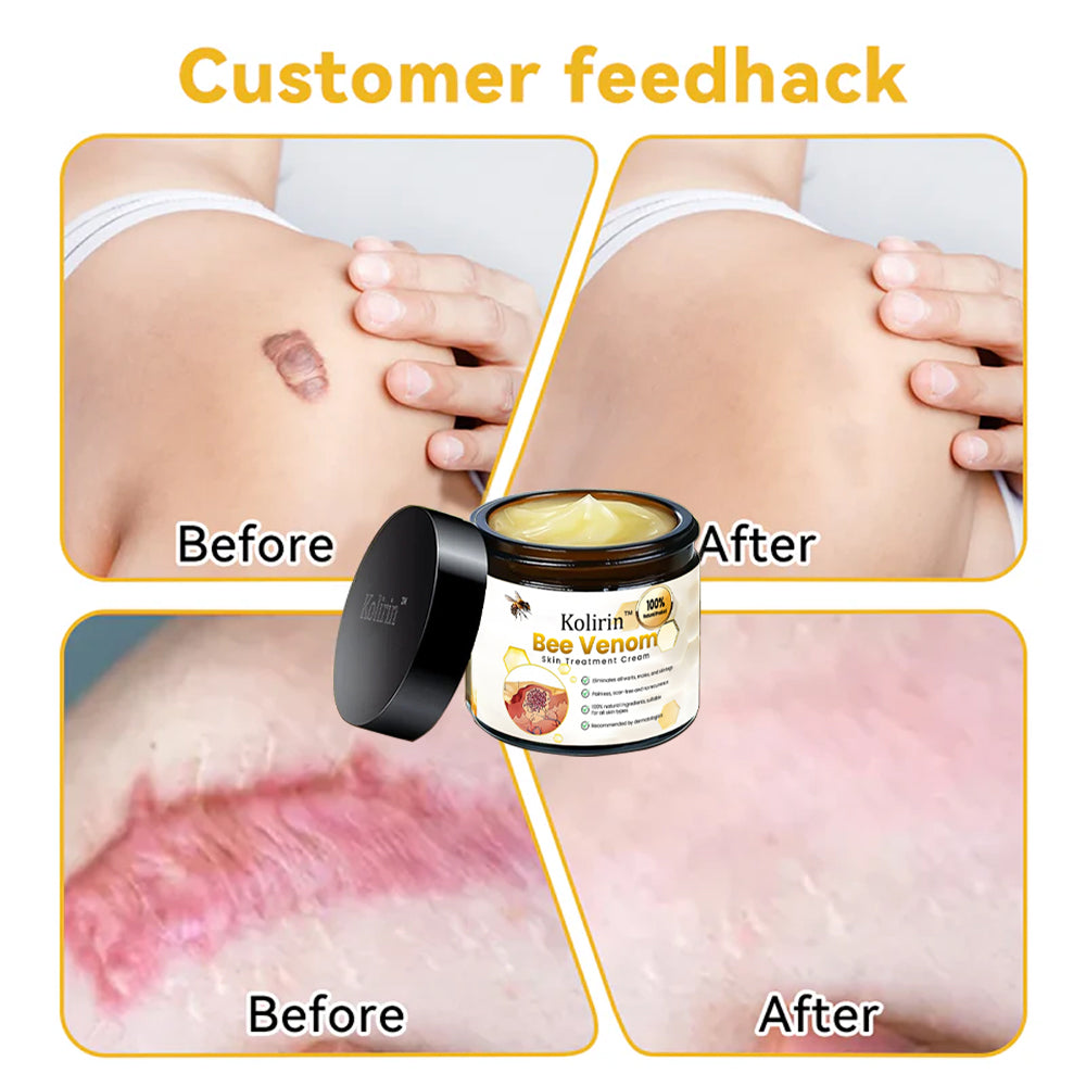 šKolirin⢠Bee Venom Skin Treatment Cream šæLimited Discounts š„