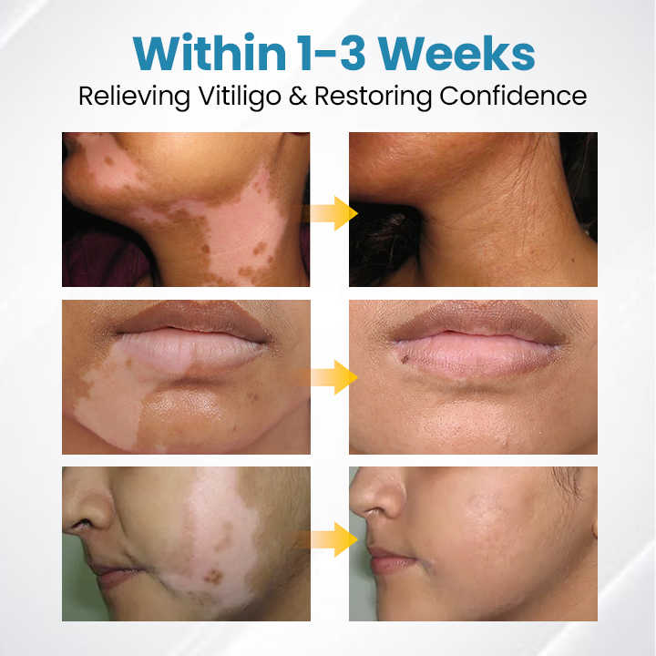 💥 VityLux® DermaBeam Vitiligo Laser Therapy System 🔆 3-5 Seconds Vitiligo Treatment - 2 Weeks To Visibly Better Skin