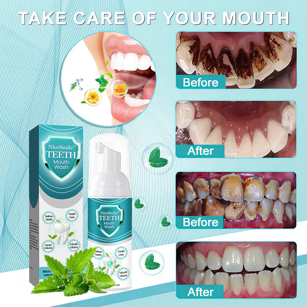 NiceSmile⢠TEETH Mouthwash - Solve All Oral Problems š„ LAST DAY SALE 70% OFF š„