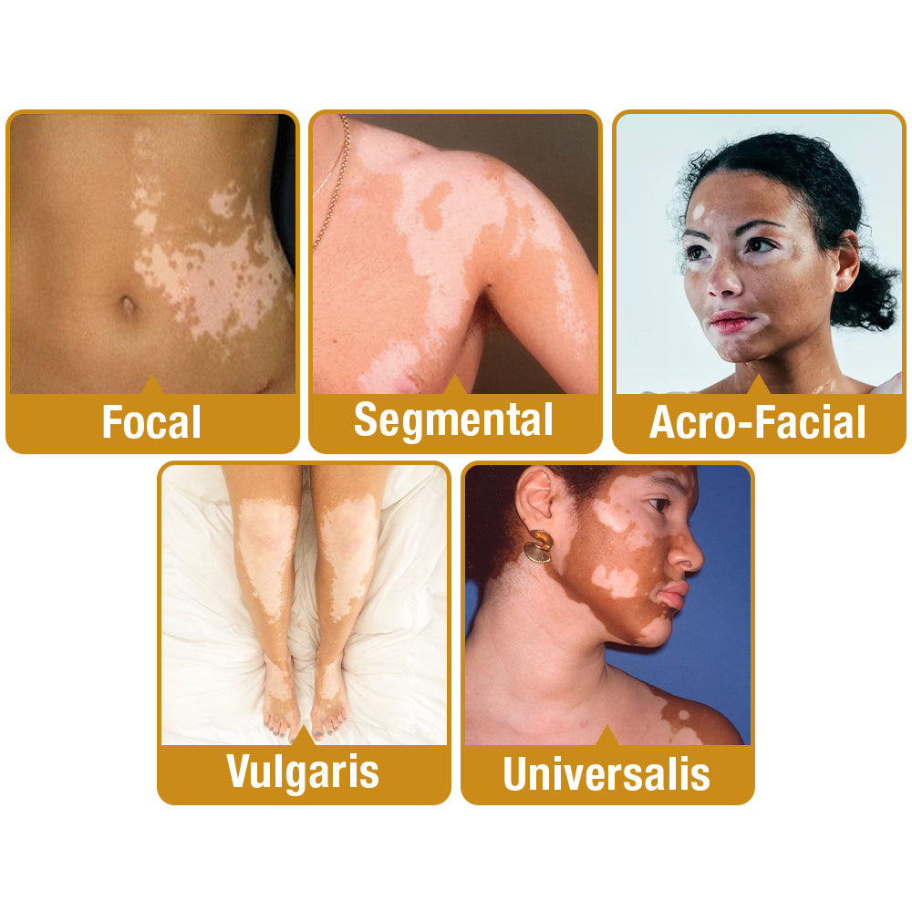 UNPREE™ VitiGO Bee Venom Treatment Cream - 🔥 LAST DAY SALE 70% OFF 🔥