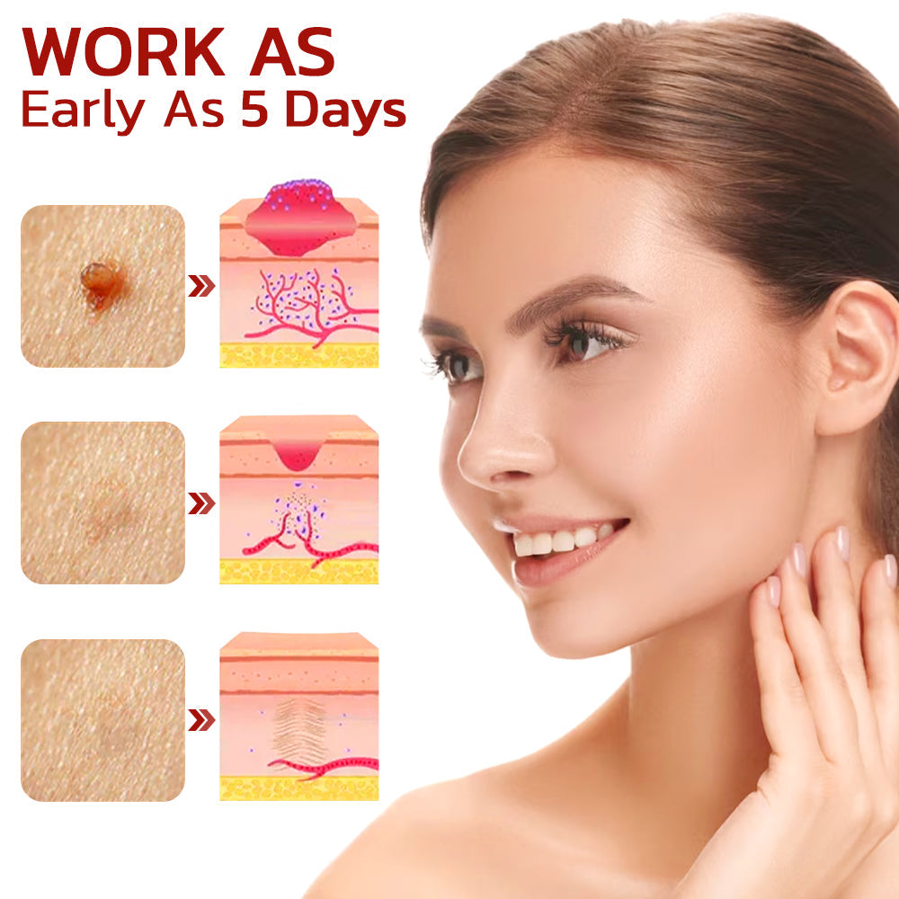 SpotAway™ WipeOff Tags And Moles Remover