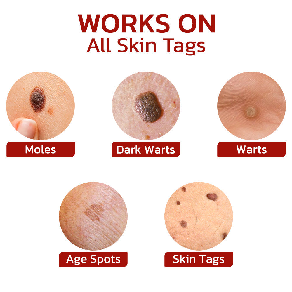 SpotAway™ WipeOff Tags And Moles Remover