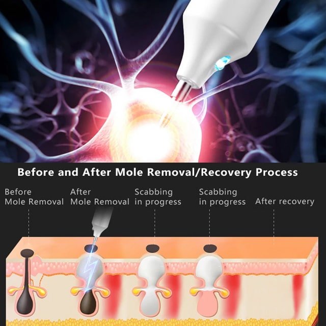 SkinFix Skin Tag Removal Laser Plasma Pen - CERTIFI CURE