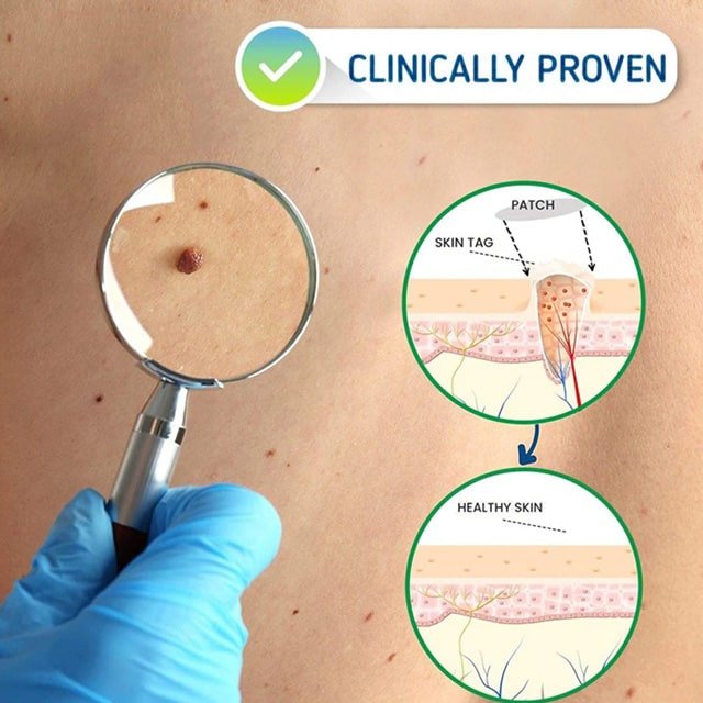 SkinFix Skin Tag Removal Laser Plasma Pen - CERTIFI CURE