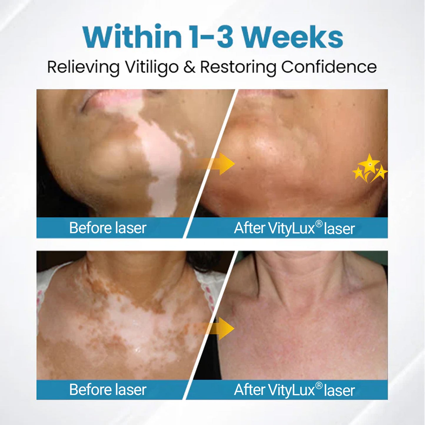 💥 VityLux® DermaBeam Vitiligo Laser Therapy System 🔆 3-5 Seconds Vitiligo Treatment - 2 Weeks To Visibly Better Skin
