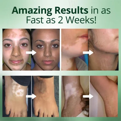 💥 2025 Hot Sale 70% OFF 🔥 Melavix Vitiligo Treatment Cream 🔆 Bring Balance Back to Your Skin