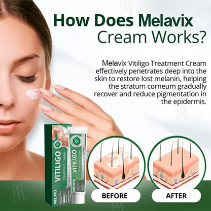 💥 2025 Hot Sale 70% OFF 🔥 Melavix Vitiligo Treatment Cream 🔆 Bring Balance Back to Your Skin