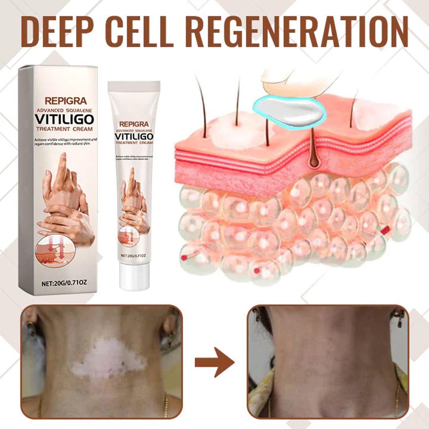 💥 2025 Mega Sale 70% OFF 🔥 Repigra Vitiligo Therapeutic Cream 🔆 Repigment With Care Every Day