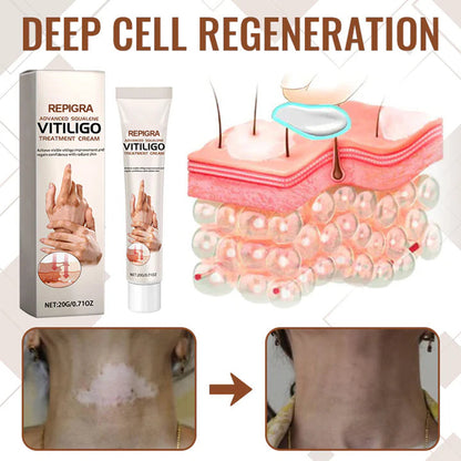 💥 2025 Mega Sale 70% OFF 🔥 Repigra Vitiligo Therapeutic Cream 🔆 Repigment With Care Every Day