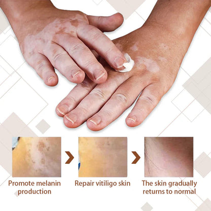 💥 2025 Mega Sale 70% OFF 🔥 Repigra Vitiligo Therapeutic Cream 🔆 Repigment With Care Every Day