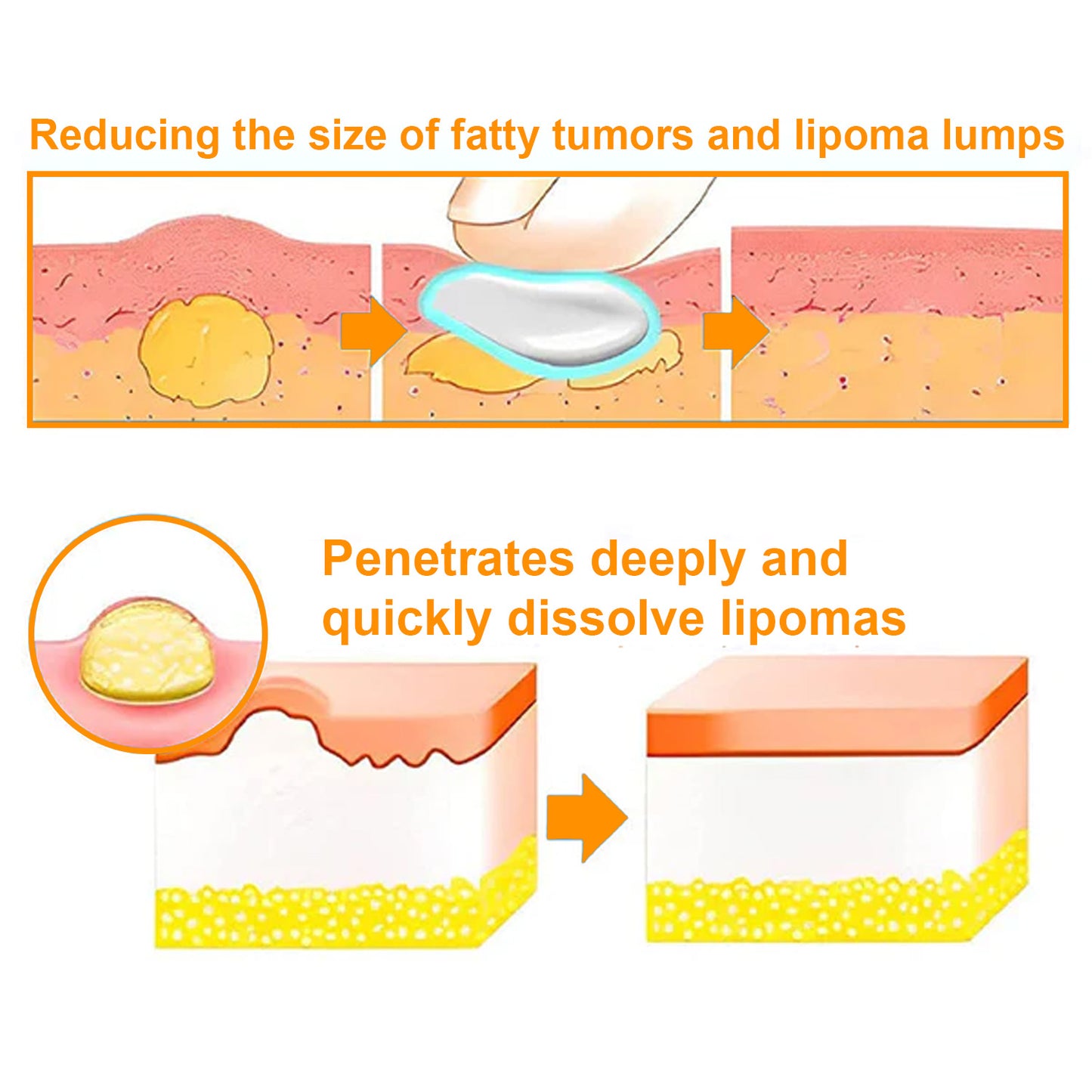 🎉 2025 Upgraded 75% OFF 🐝 Venexa™ Bee Venom Lipoma Treatment Cream 🌿 Visible Results in 2 Weeks!