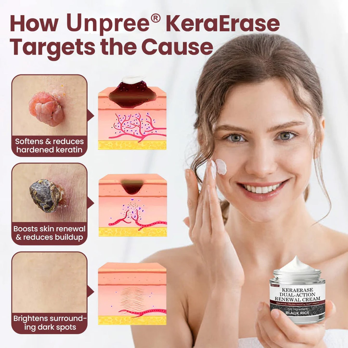 🔥 2026 Holiday Sale 70% OFF ✨ Unpree® KeraErase Dual-Action Renewal Cream