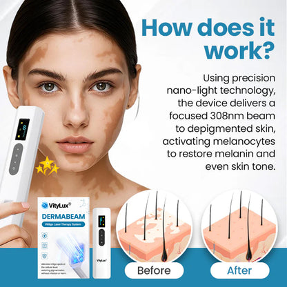 💥 VityLux® DermaBeam Vitiligo Laser Therapy System 🔆 3-5 Seconds Vitiligo Treatment - 2 Weeks To Visibly Better Skin