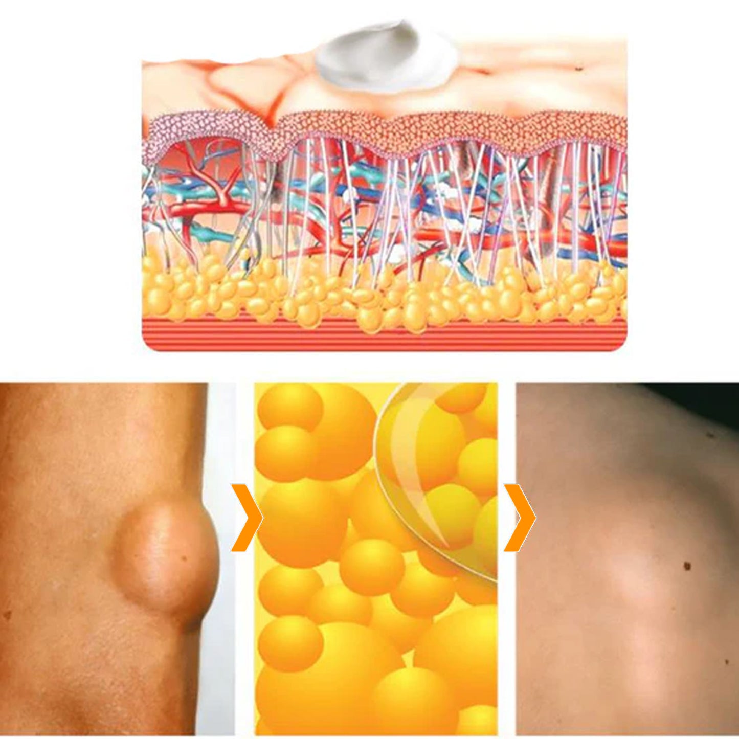 🎉 2025 Upgraded 75% OFF 🐝 Venexa™ Bee Venom Lipoma Treatment Cream 🌿 Visible Results in 2 Weeks!