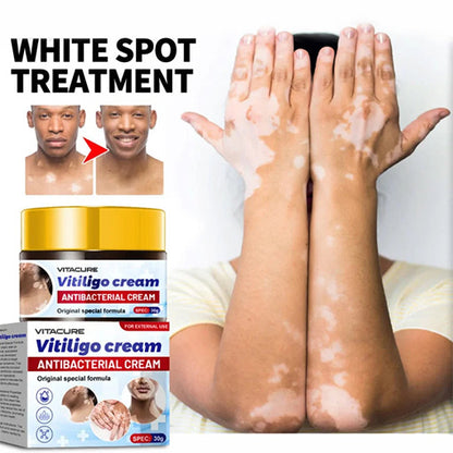 💥 2025 Big Sale 70% OFF 🔥 Vitacure Antibacterial Vitiligo Cream 🔆 Gentle Touch - Visible Change