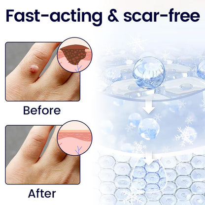 🔥 2026 Holiday Sale 70% OFF ✨ Unpree® WartErase Cryo Freeze Spray