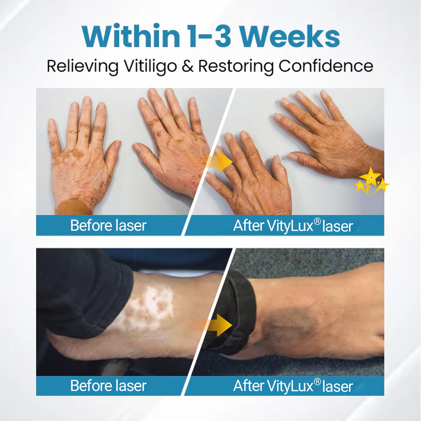 💥 VityLux® DermaBeam Vitiligo Laser Therapy System 🔆 3-5 Seconds Vitiligo Treatment - 2 Weeks To Visibly Better Skin