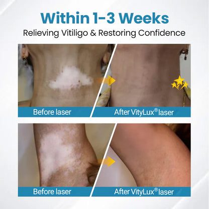💥 VityLux® DermaBeam Vitiligo Laser Therapy System 🔆 3-5 Seconds Vitiligo Treatment - 2 Weeks To Visibly Better Skin