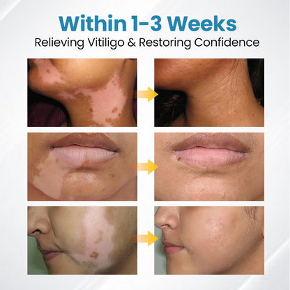 💥 VityLux® DermaBeam Vitiligo Laser Therapy System 🔆 3-5 Seconds Vitiligo Treatment - 2 Weeks To Visibly Better Skin