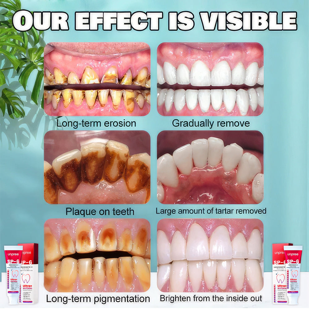 👨‍⚕️👨‍⚕️[✨𝐎𝐟𝐟𝐢𝐜𝐢𝐚𝐥 𝐁𝐫𝐚𝐧𝐝 𝐒𝐭𝐨𝐫𝐞✨] Unpree™ SP-6 Ultra+ Probiotic Whitening Toothpaste (👨‍⚕𝐀𝐃𝐀 𝐑𝐄𝐂𝐎𝐌𝐌𝐄𝐍𝐃𝐒)