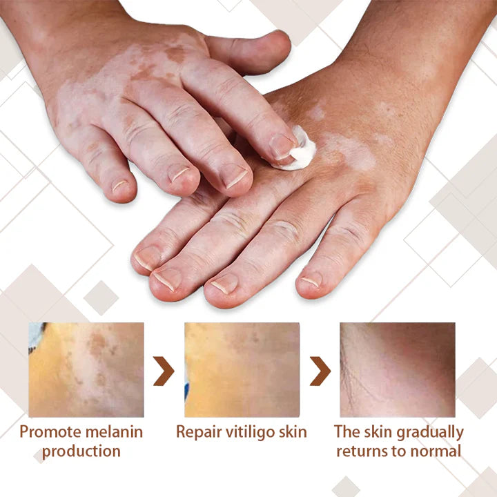 💥 2025 Mega Sale 70% OFF 🔥 Repigra Vitiligo Therapeutic Cream 🔆 Repigment With Care Every Day