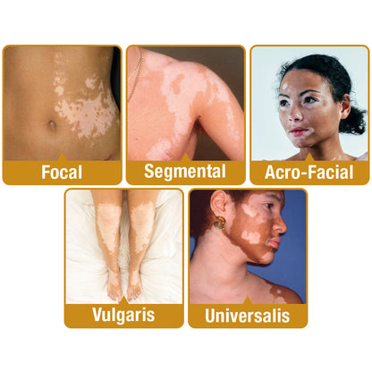 UNPREE™ VitiGO Bee Venom Treatment Cream - 🔥 LAST DAY SALE 70% OFF 🔥