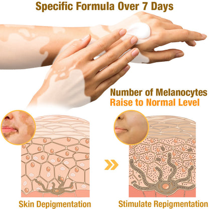 UNPREE™ VitiGO Bee Venom Treatment Cream - 🔥 LAST DAY SALE 70% OFF 🔥