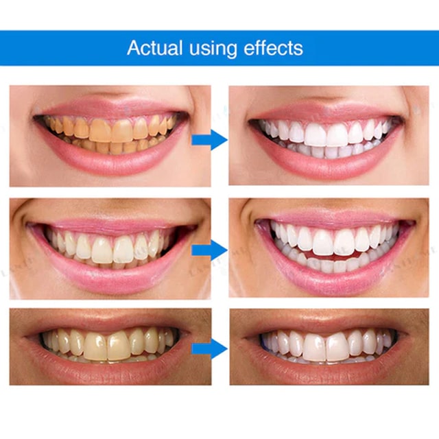 LANTHOME™ Teeth Whitening Essence