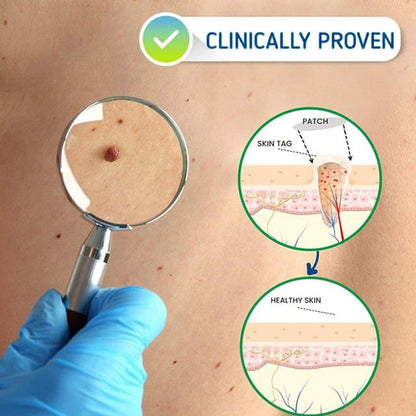 SkinFix Skin Tag Removal Laser Plasma Pen - CERTIFI CURE